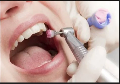 Teeth Cleaning & Polishing 