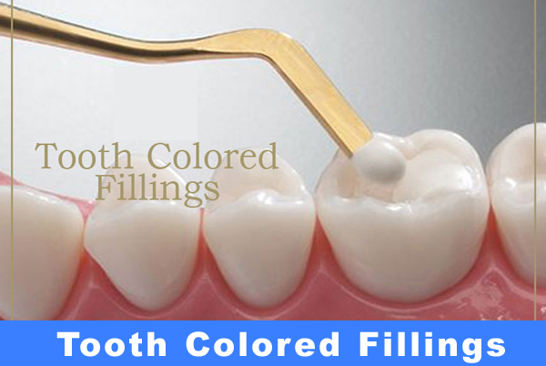 Tooth Coloured Fillings