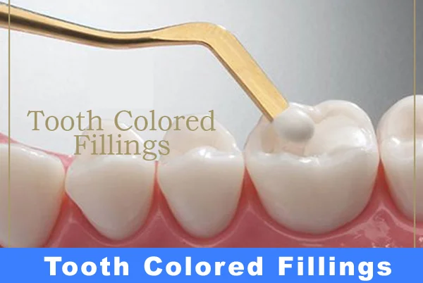 Tooth Coloured Fillings