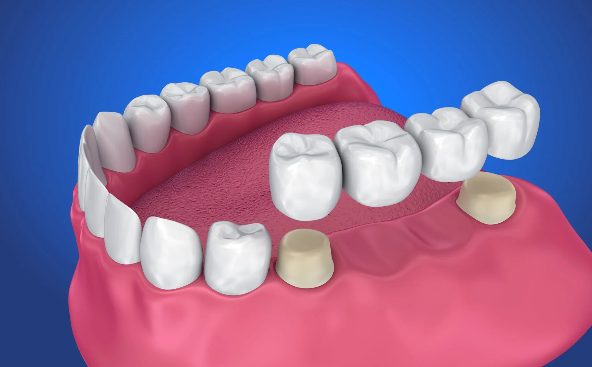 Ceramic Crown & Bridge