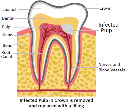Pulpotomy