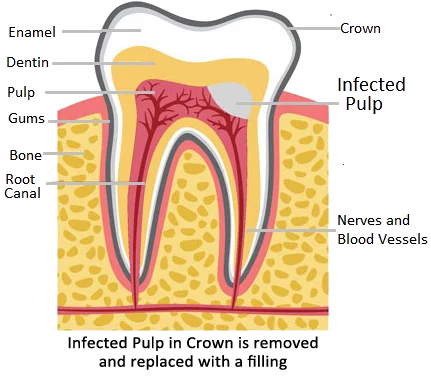 Pulpotomy