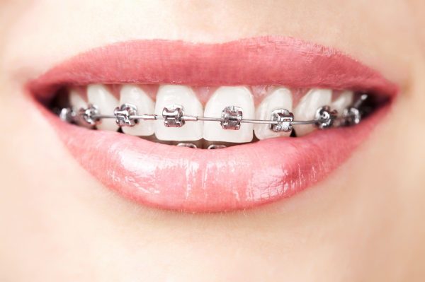 Metal Braces 