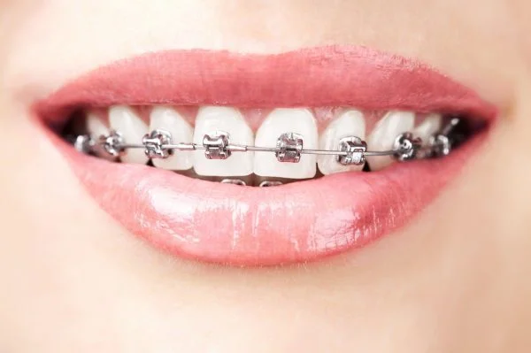 Metal Braces 