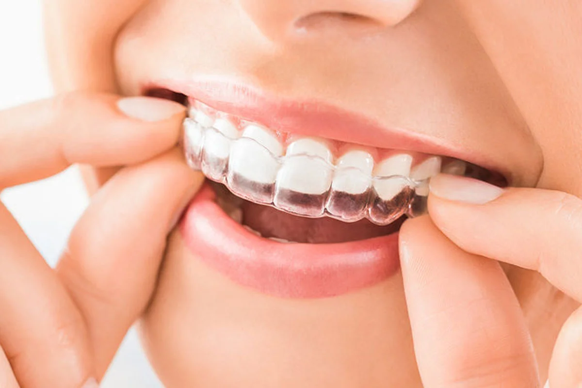 Aligners 