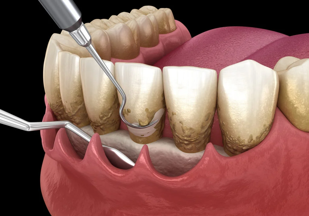 Periodontal Surgery